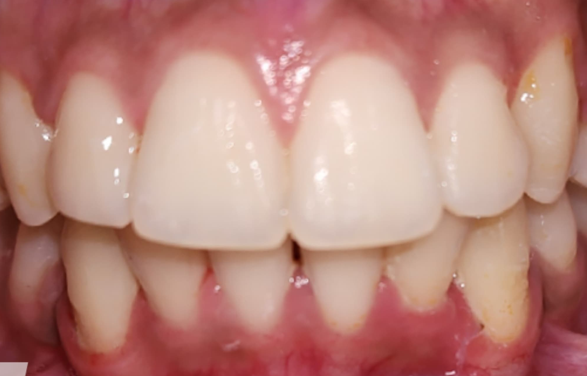 Teeth Whitening & Bleaching - After